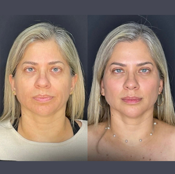 Preenchimento Facial